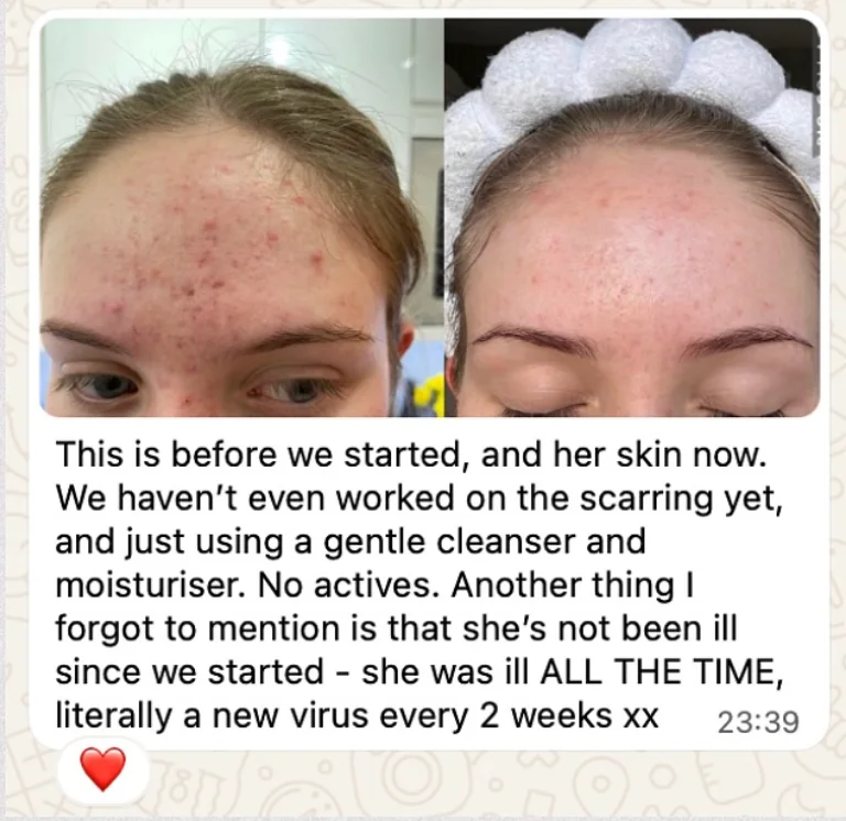 A student shares a client's before and after: "This is before we started, and her skin now. We haven't even worked on the scarring yet, and just using a gentle cleanser and moisturiser. No actives." She adds the client has not been ill since they started, having previously been ill constantly.