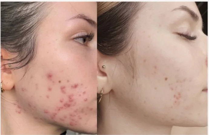 A client of Holly at Glow Moore Skin, before and after, inflamed cheek acne cleared
