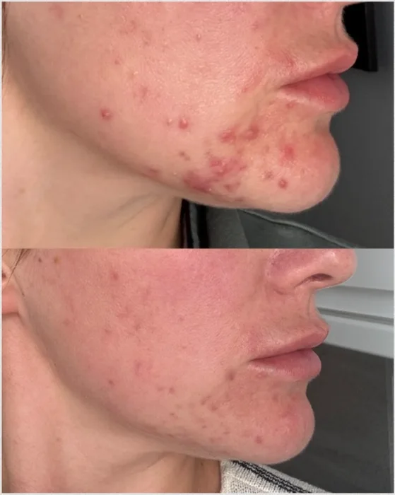 A client of Paige at Foxie Skin Clinic, before and after, jawline and cheek acne cleared