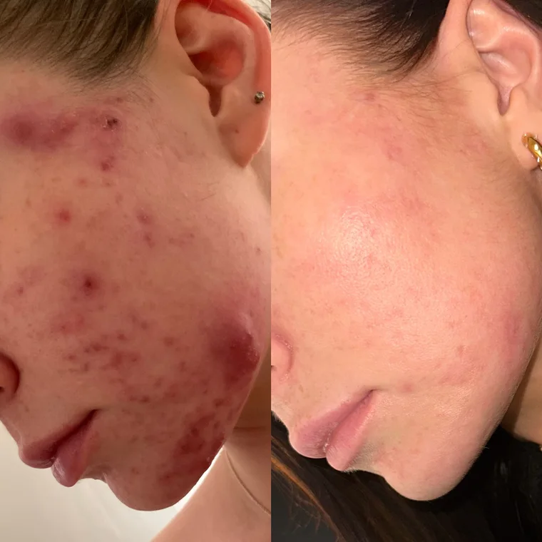 A client of Scarlett at SKN by Scarlett, before and after, cheek acne cleared